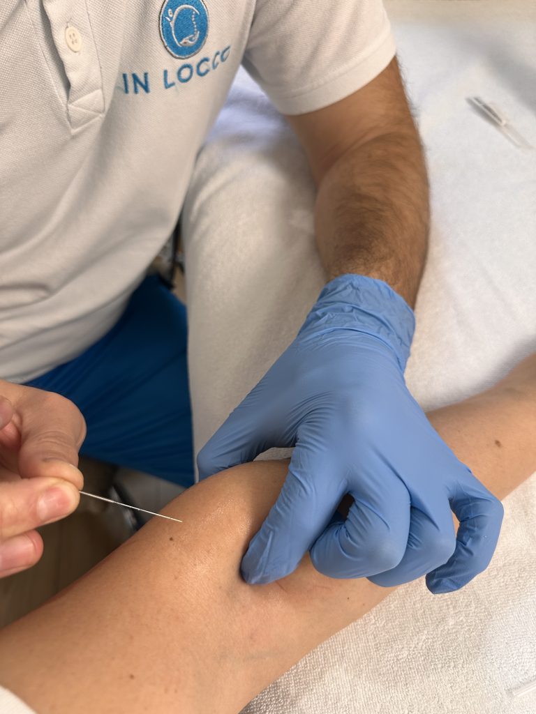 dry needling