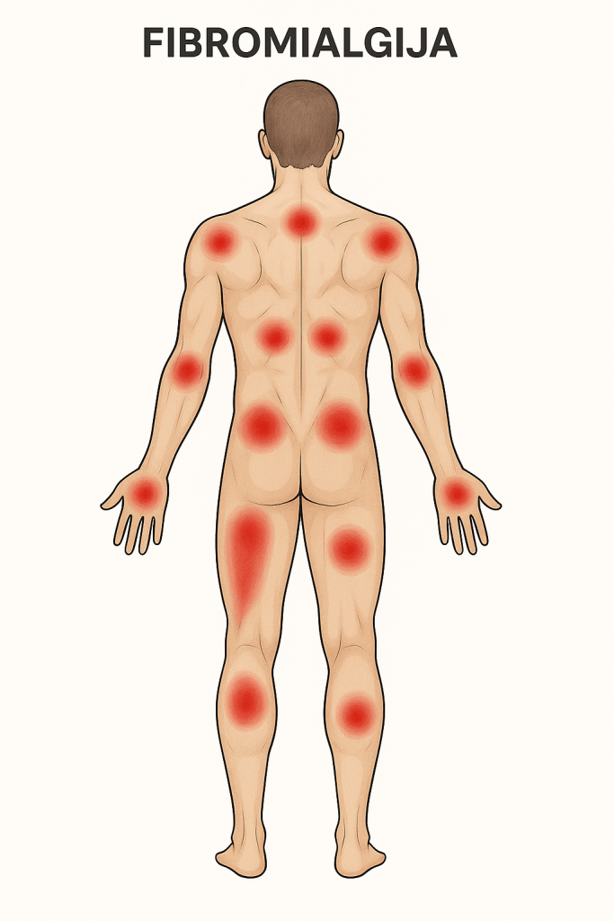 Fibromialgija