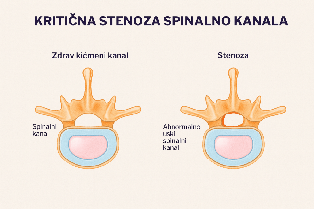 kritična stenoza spinalnog kanala